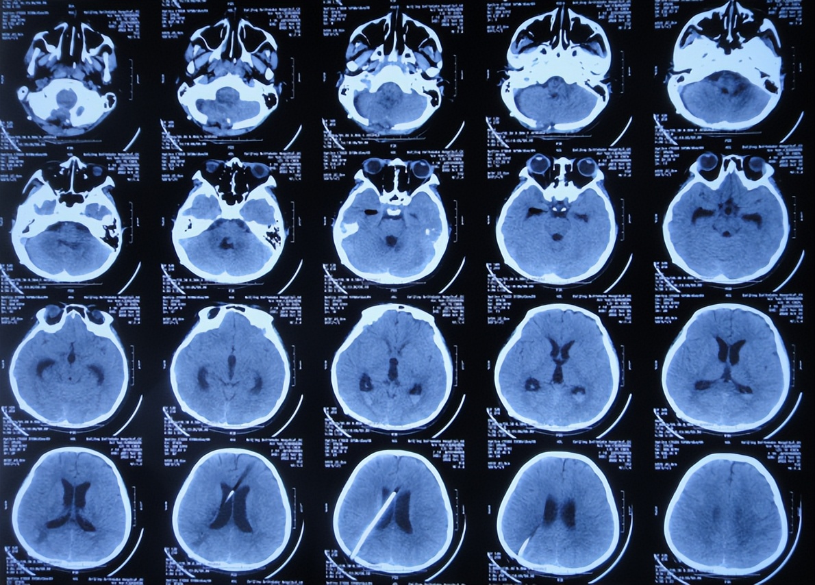 脑干出血儿童,儿童脑干胶质瘤呕吐