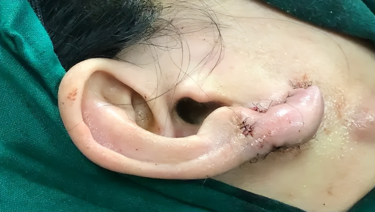 耳朵疤痕疙瘩治疗需要多少钱？