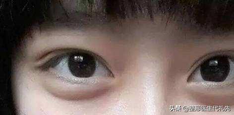 眼轮匝肌肥厚型眼袋的治疗体会,眼轮匝肌肥厚型眼袋怎么外切
