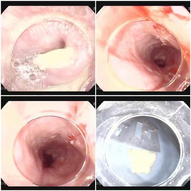 安塞区人民医院：“镜”艺求精巧取羊骨