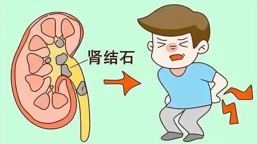 如何预防泌尿系统结石,对于泌尿系结石最有效的预防方法