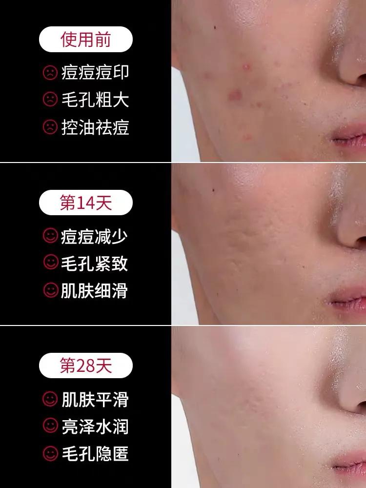 男生怎么祛痘印有效啊,祛痘印痘坑修复男生