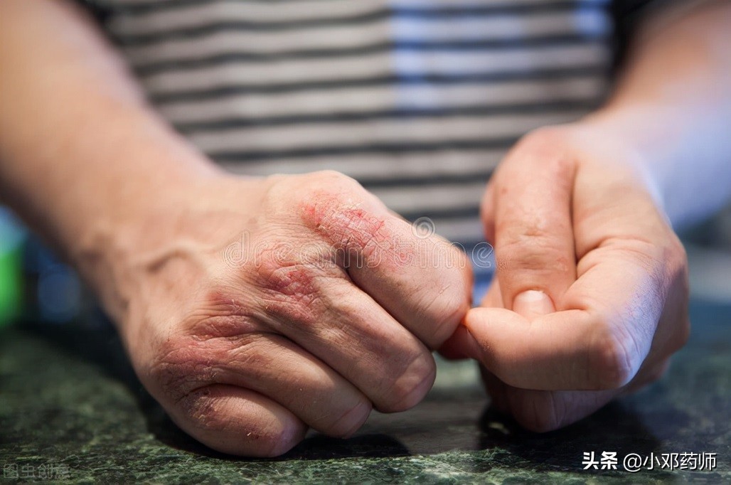 儿童银屑病擦他卡西醇会变红吗,面部银屑病能用他卡西醇