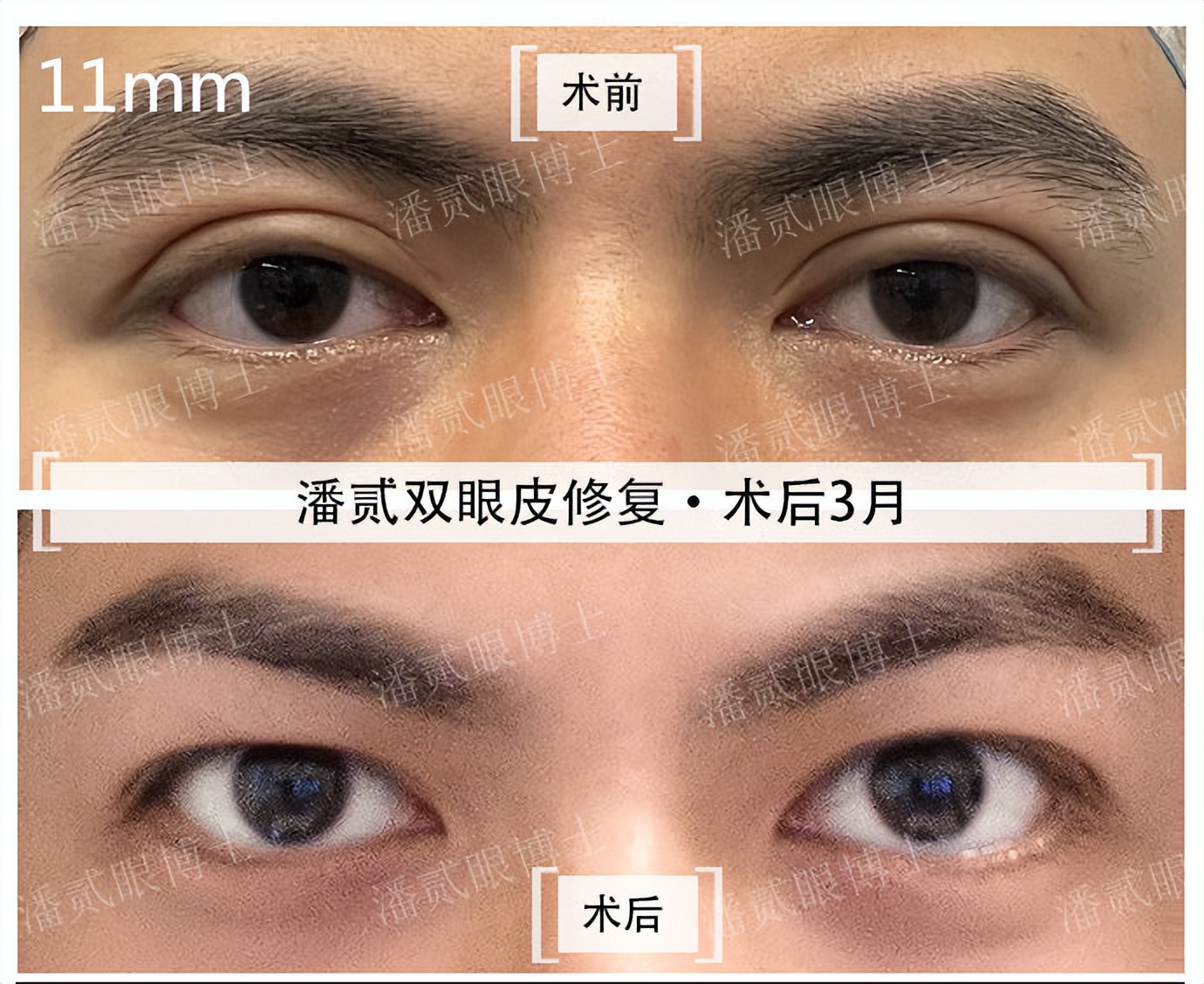 上海宽改窄双眼皮修复案例对比,宽变窄双眼皮修复过程对比
