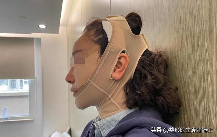 小拉皮能改善下颌线吗,拉皮手术改善下颌线