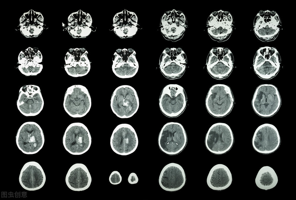 脑梗走路不稳吃胞磷胆碱钠,预防脑梗可服胞磷胆碱钠胶囊吗