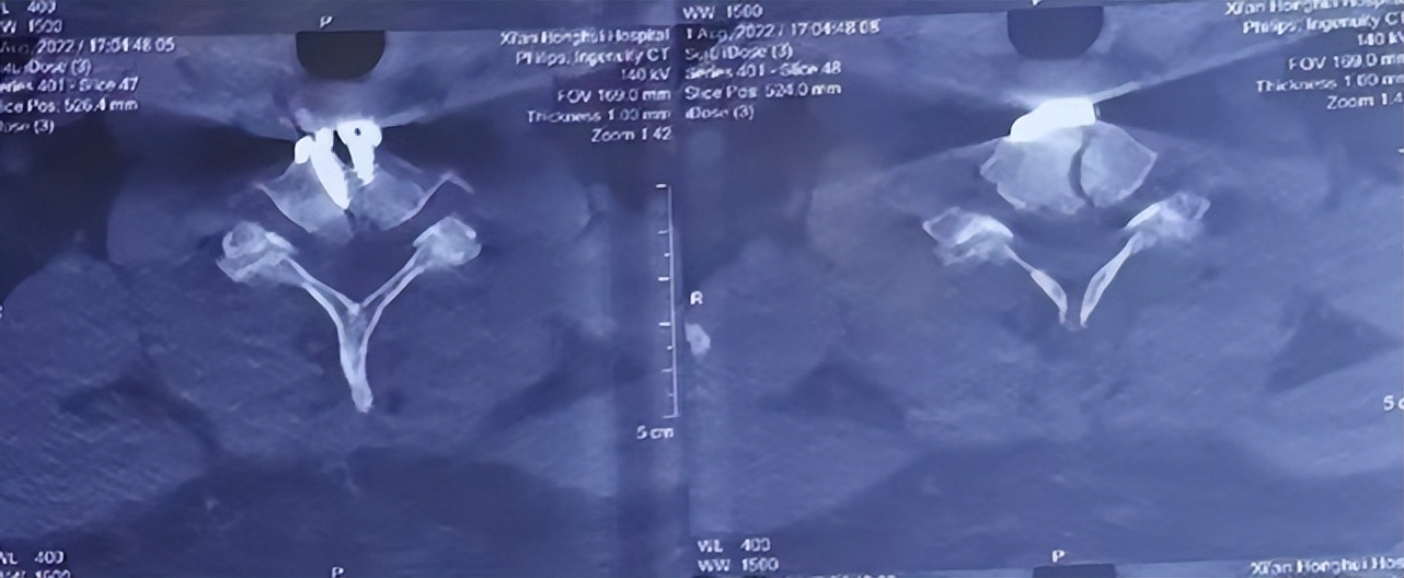 救治背部被砸伤男子,男子救人被砸中在icu抢救超24小时