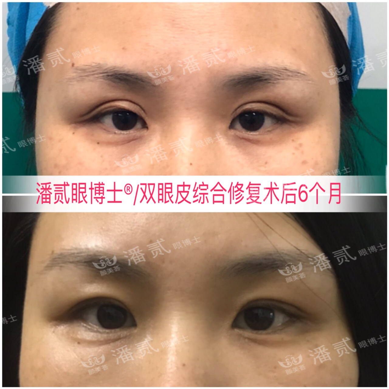 东莞整形做双眼皮,东莞整形医院割双眼皮