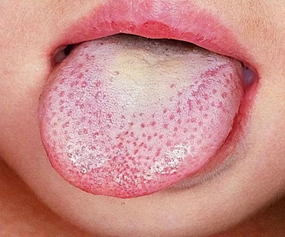 小儿舌头的各种症状如何解决,儿童舌头红色颗粒状怎么治疗