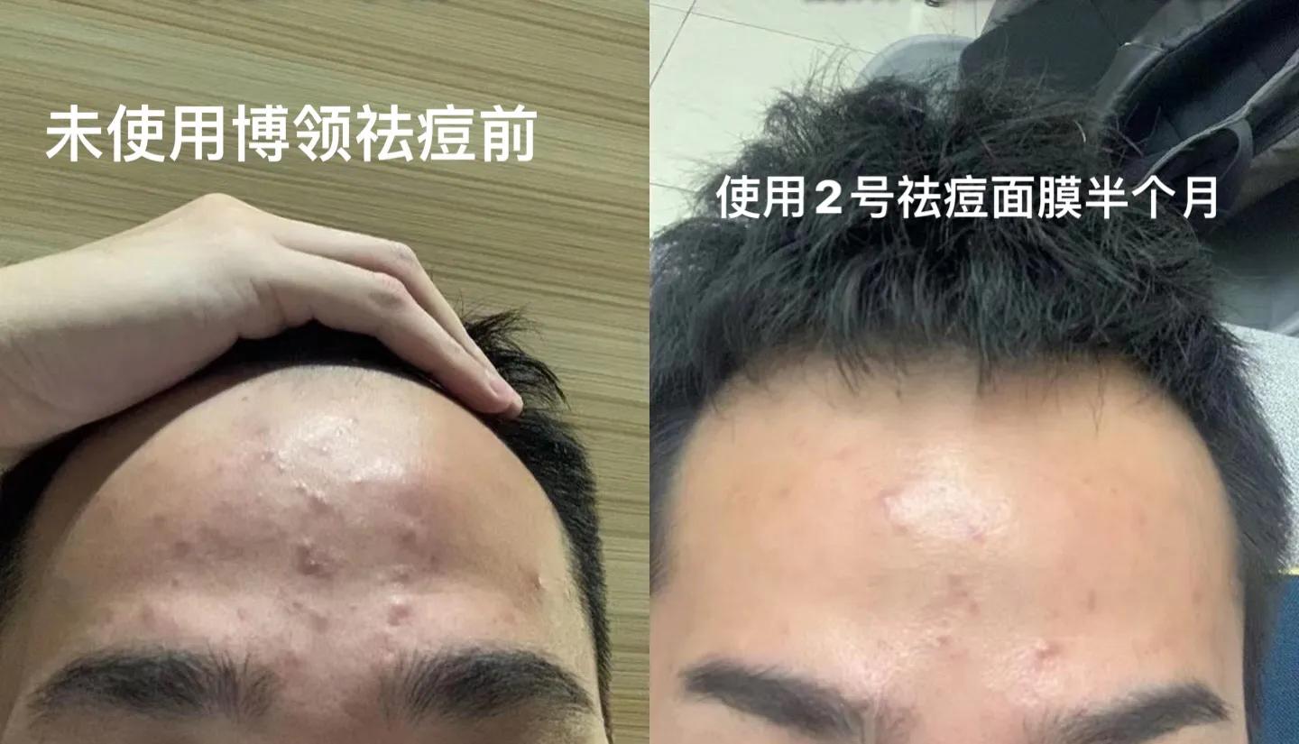 男生祛痘印洗面奶推荐,男生如何有效祛痘印