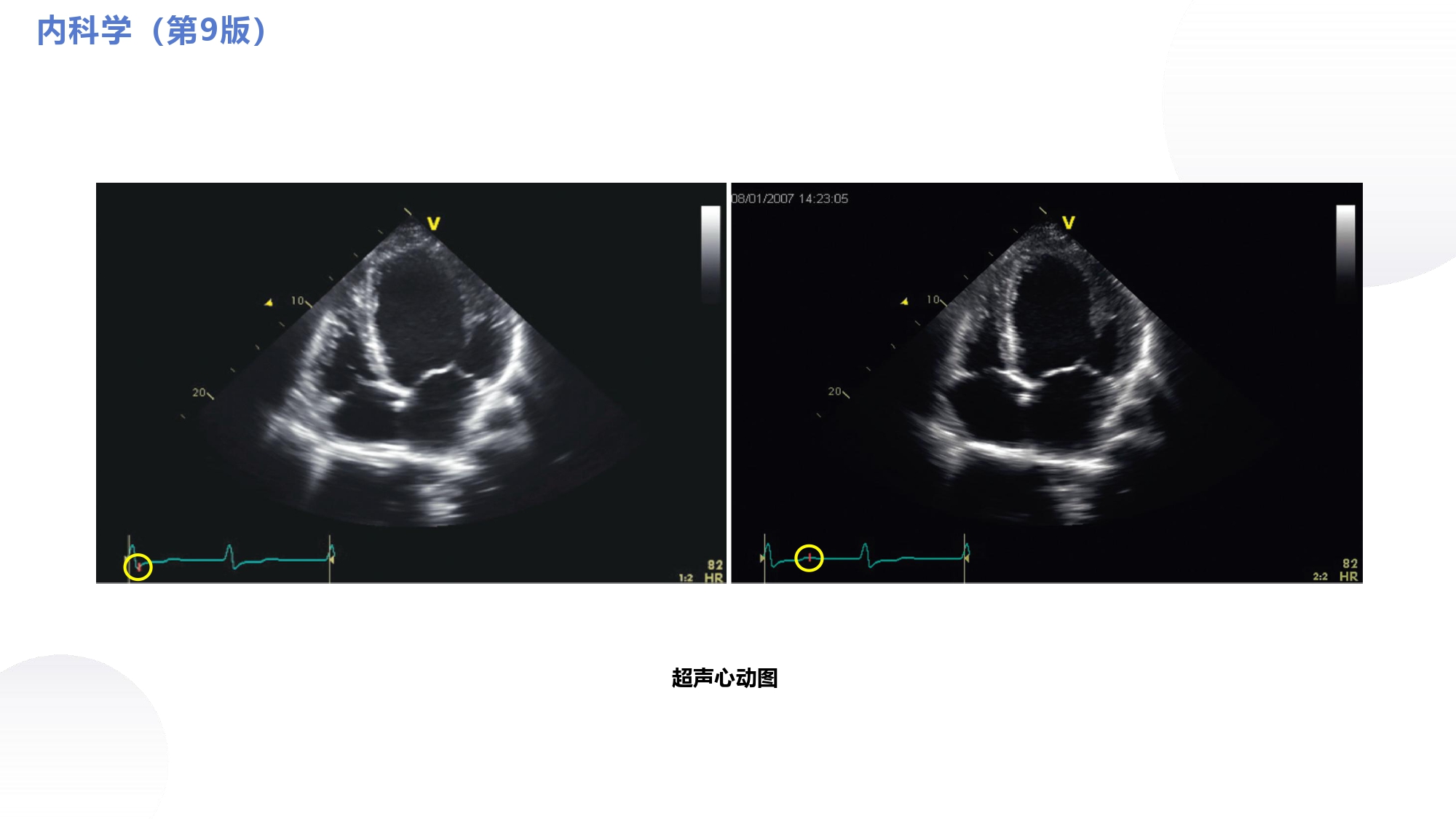 循环系统心脏讲解视频,循环系统心律失常教学视频