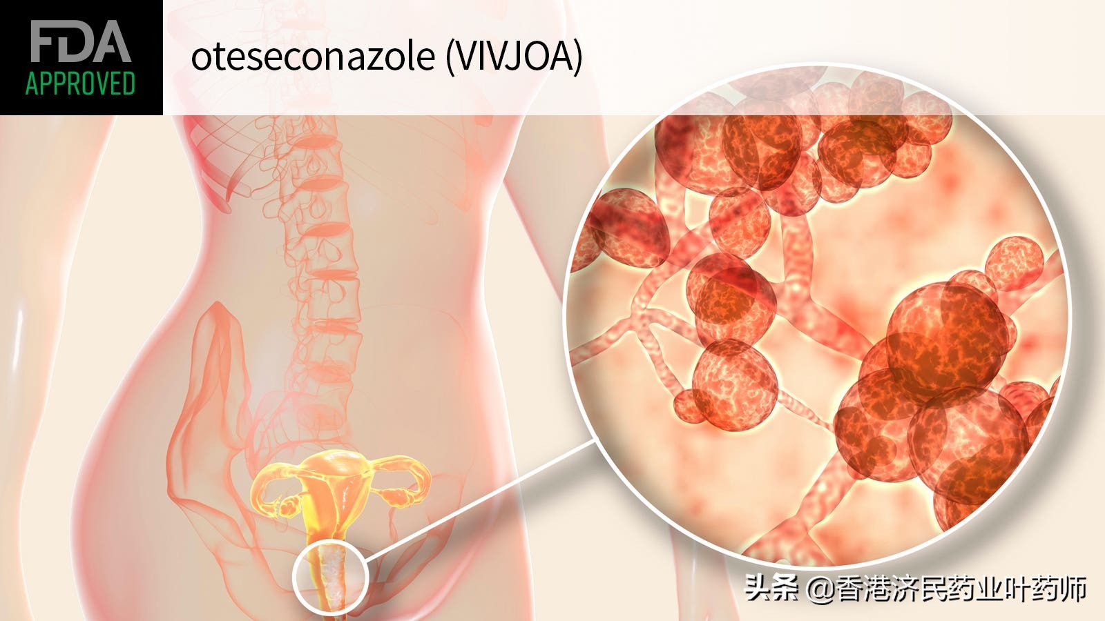 复发性外阴阴道念珠菌病首个药物！FDA批准Vivjoa,oteseconazole
