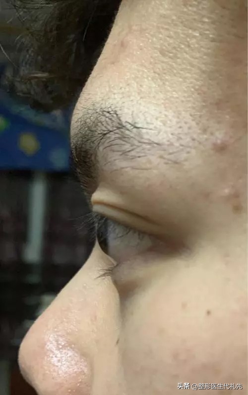 眼球鼓做全切双眼皮,全切双眼皮缝合位置有凸起小疙瘩