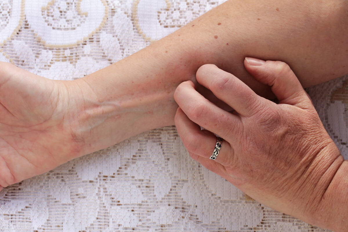 得了麻疹特别痒不管没事吧,得了麻疹特别痒没治不伤筋不动骨