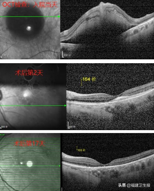 爱尔眼科专注摘镜手术,福州爱尔眼科医院技术