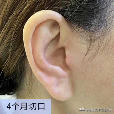 拉皮手术后13天效果图,拉皮术后1-7天照片