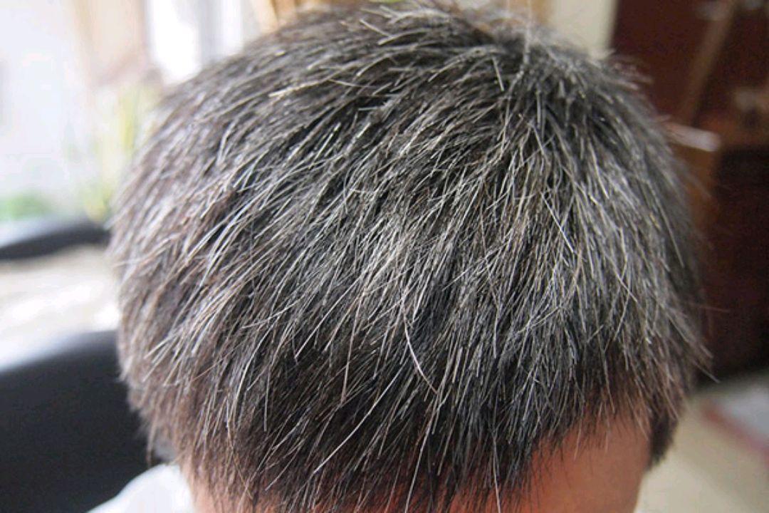 白发严重是缺少哪种维生素,白发在哪长病就出在哪