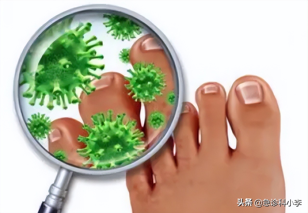 脚气反反复复怎么才能治好,脚气总是反反复复怎么治