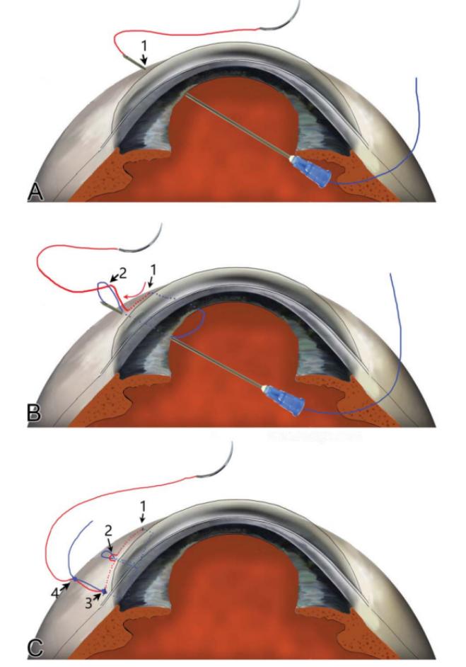 同济大学附属上海东方医院金海鹰教授：巩膜层间缝纫机技术要点