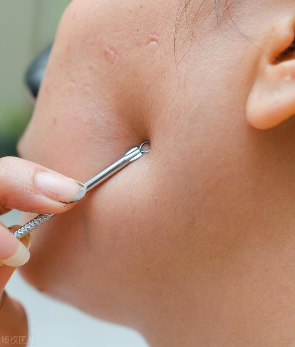 痘印痘疤不用药怎样才能消除更快,治疗痘痘痘印的最有效的药膏