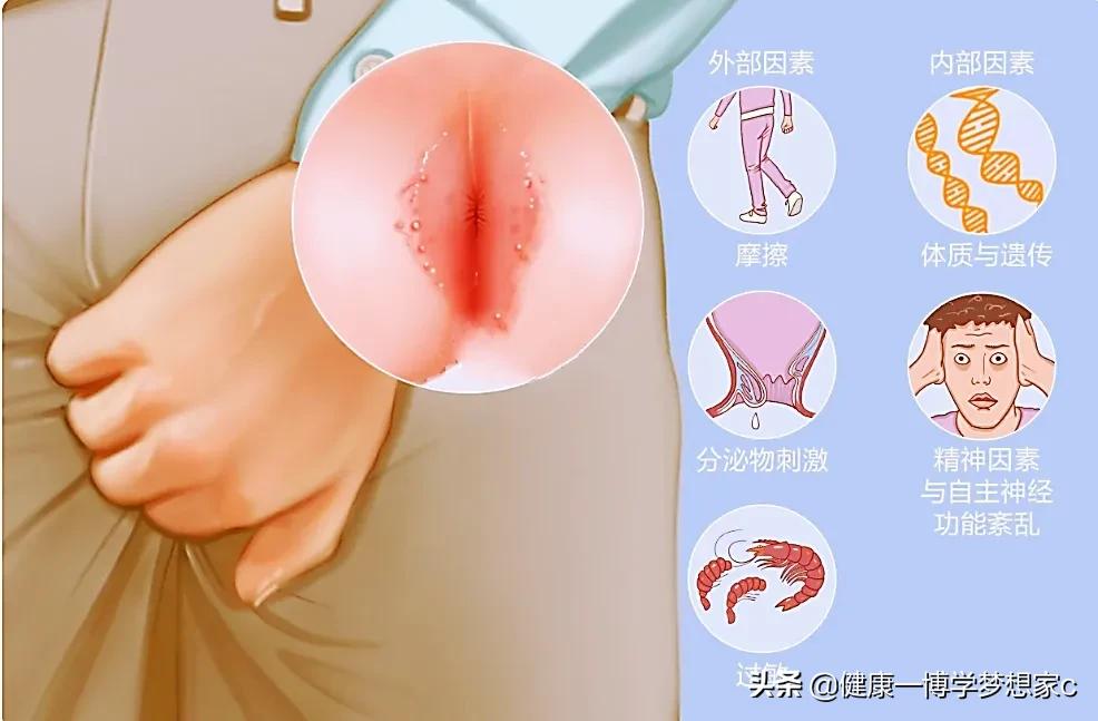 女人肛门痒怎么治疗,女肛门痒痒怎么治疗