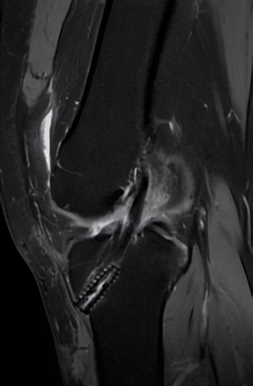 韧带断裂微创手术能恢复正常吗,打篮球韧带断裂做手术多少钱