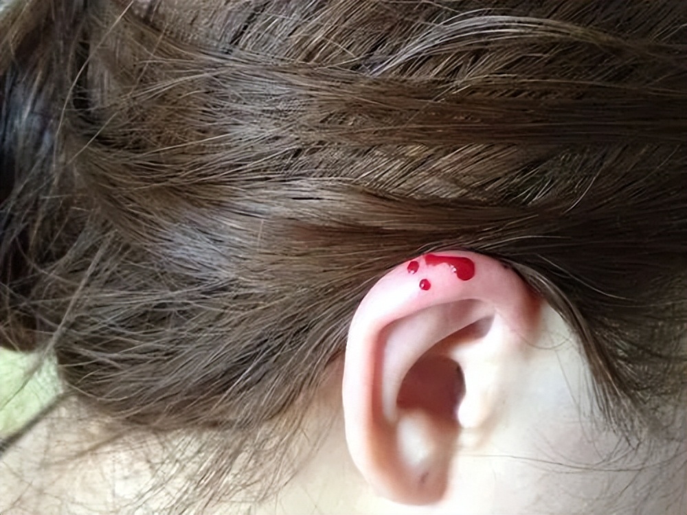 眼睛长麦粒肿怎么快速治疗,麦粒肿为什么会引起眼内长痘