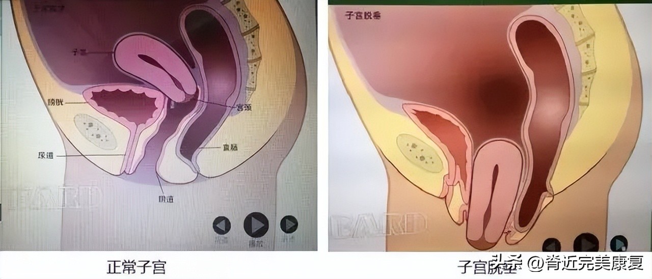 盆底功能障碍性疾病怎么治疗,盆底功能障碍治疗多少钱