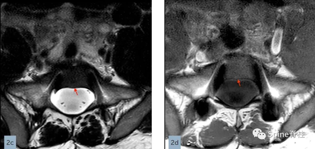 硬膜扩张,duralectasia