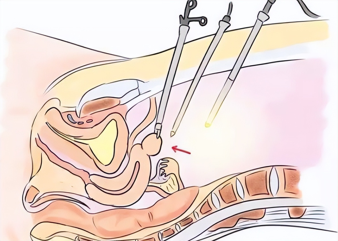 宫、腹腔镜联合手术，一次性解决两大难题！
