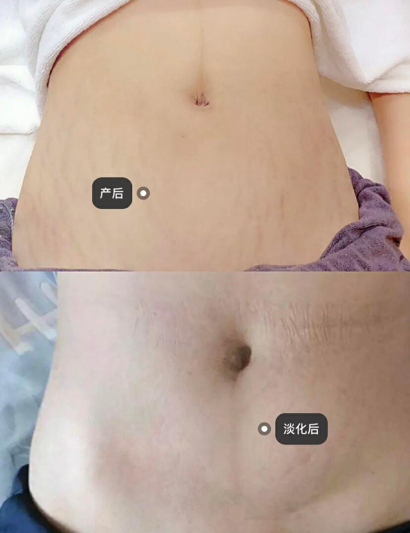 涂妊娠油真的可以不长妊娠纹吗,哪种妊娠纹油好用