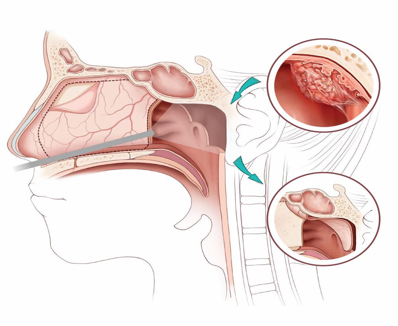 鼻咽癌的4种放疗方式