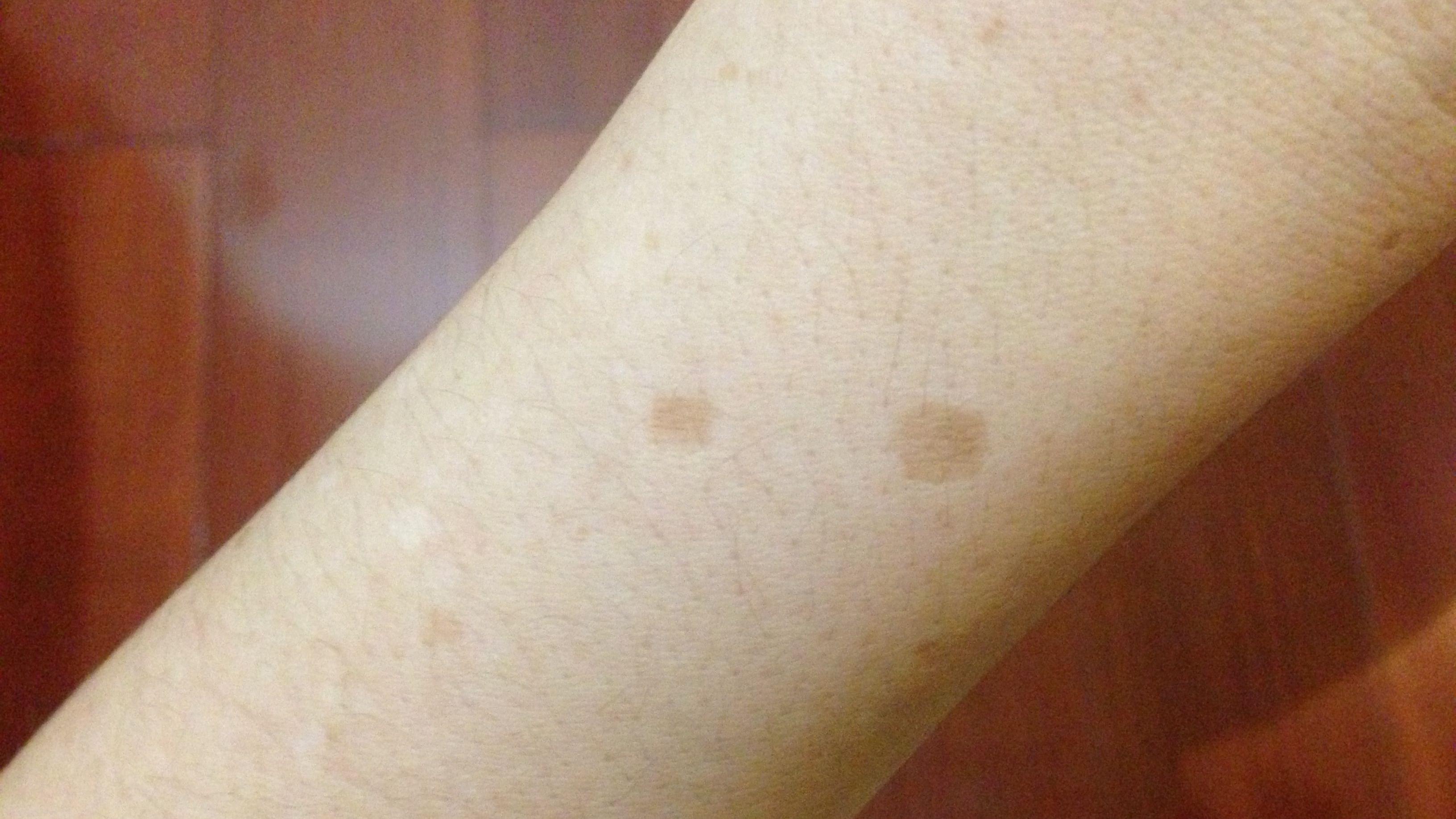 什么药可以去老年斑最有效,老人斑用什么药膏擦最有效