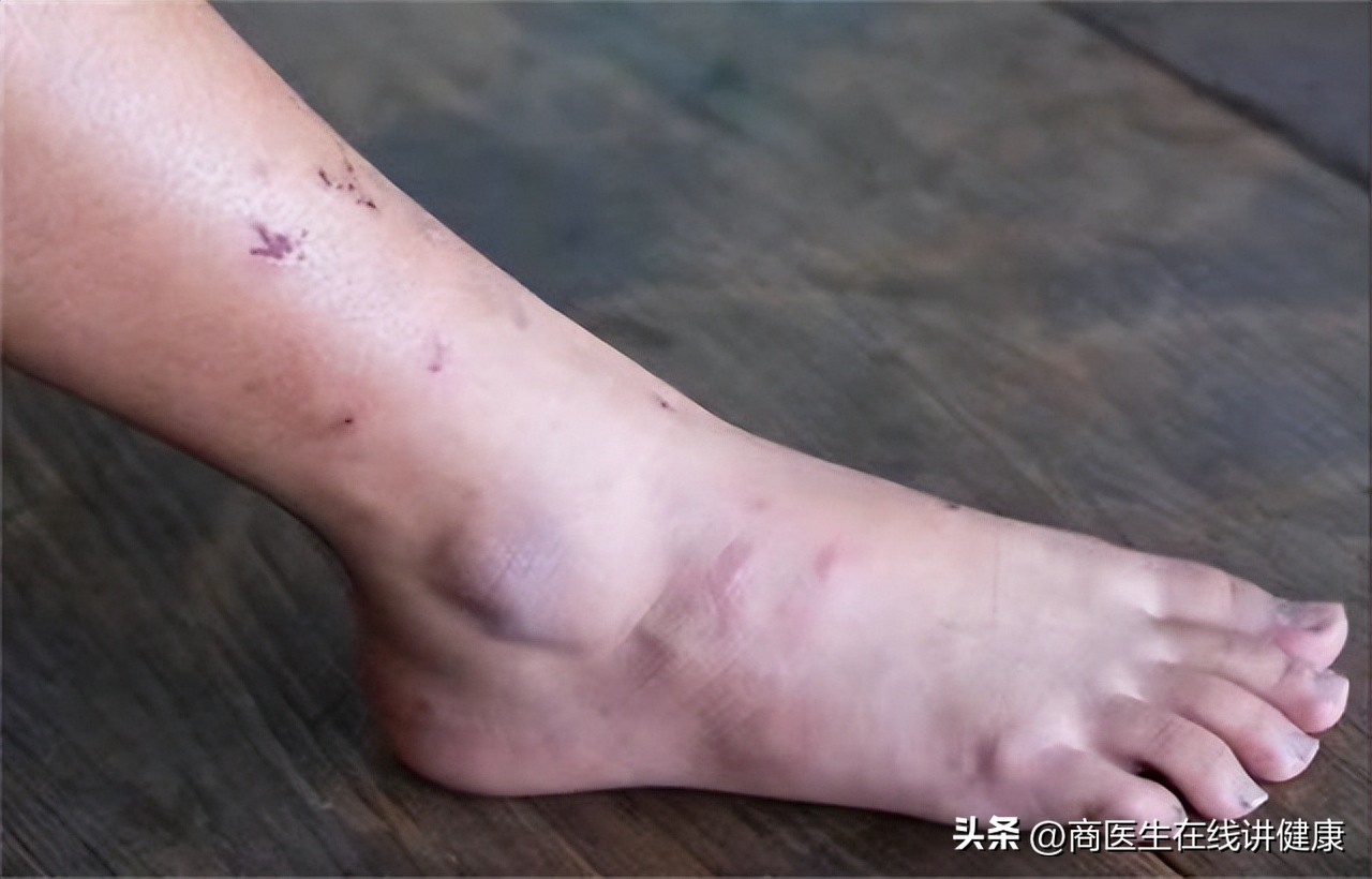 血糖看脚部六个变化,血糖高看脚什么意思