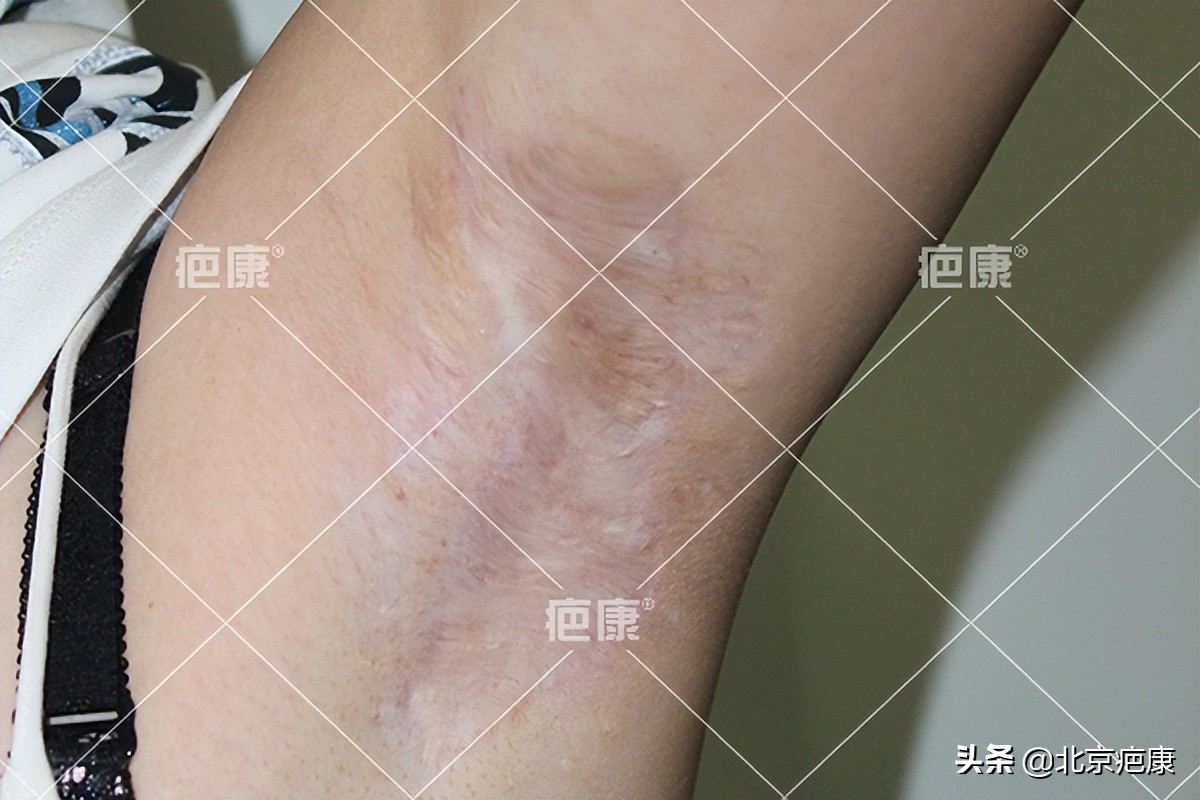 手术后刀口增生怎么办,做完腋下手术后留疤