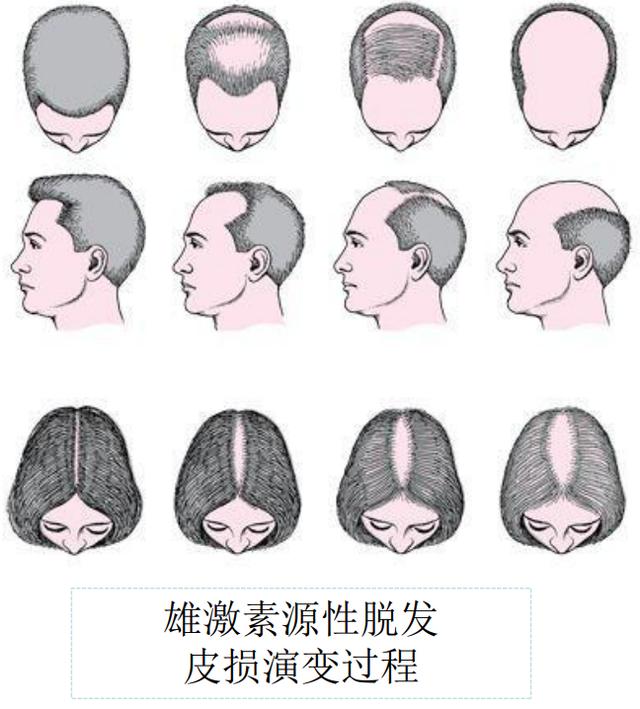 雄激素脱发用什么洗发水好,怎么确定自己是雄激素脱发