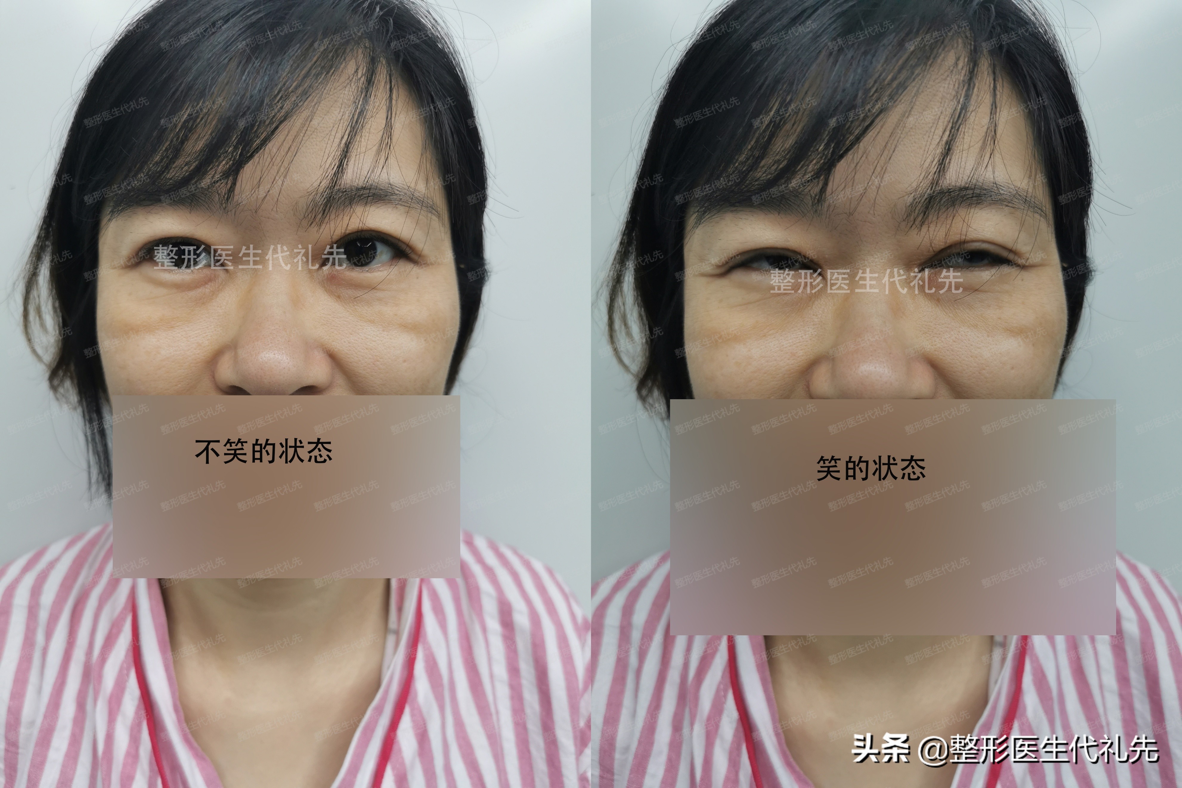 眼窝凹陷做了眼综合恢复,内双肿眼泡眼窝凹陷怎么手术