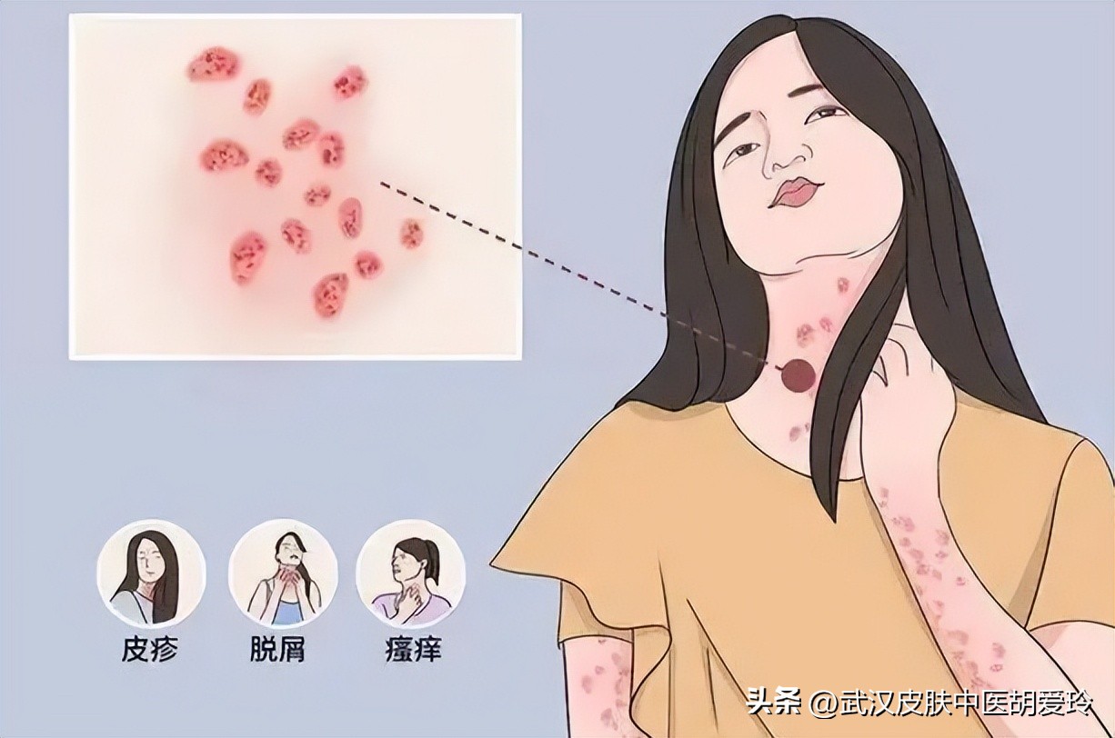 玫瑰糠疹能吃什么清热解毒药,玫瑰糠疹的皮疹用什么药物消退