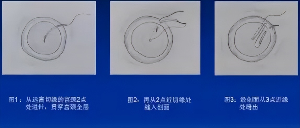 宫颈锥切手术的操作能力和技巧