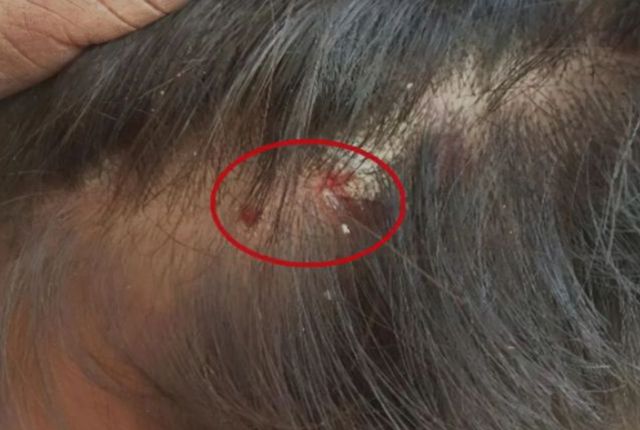 头皮上长红疙瘩脓包是什么原因,头皮经常起小脓包疙瘩很疼