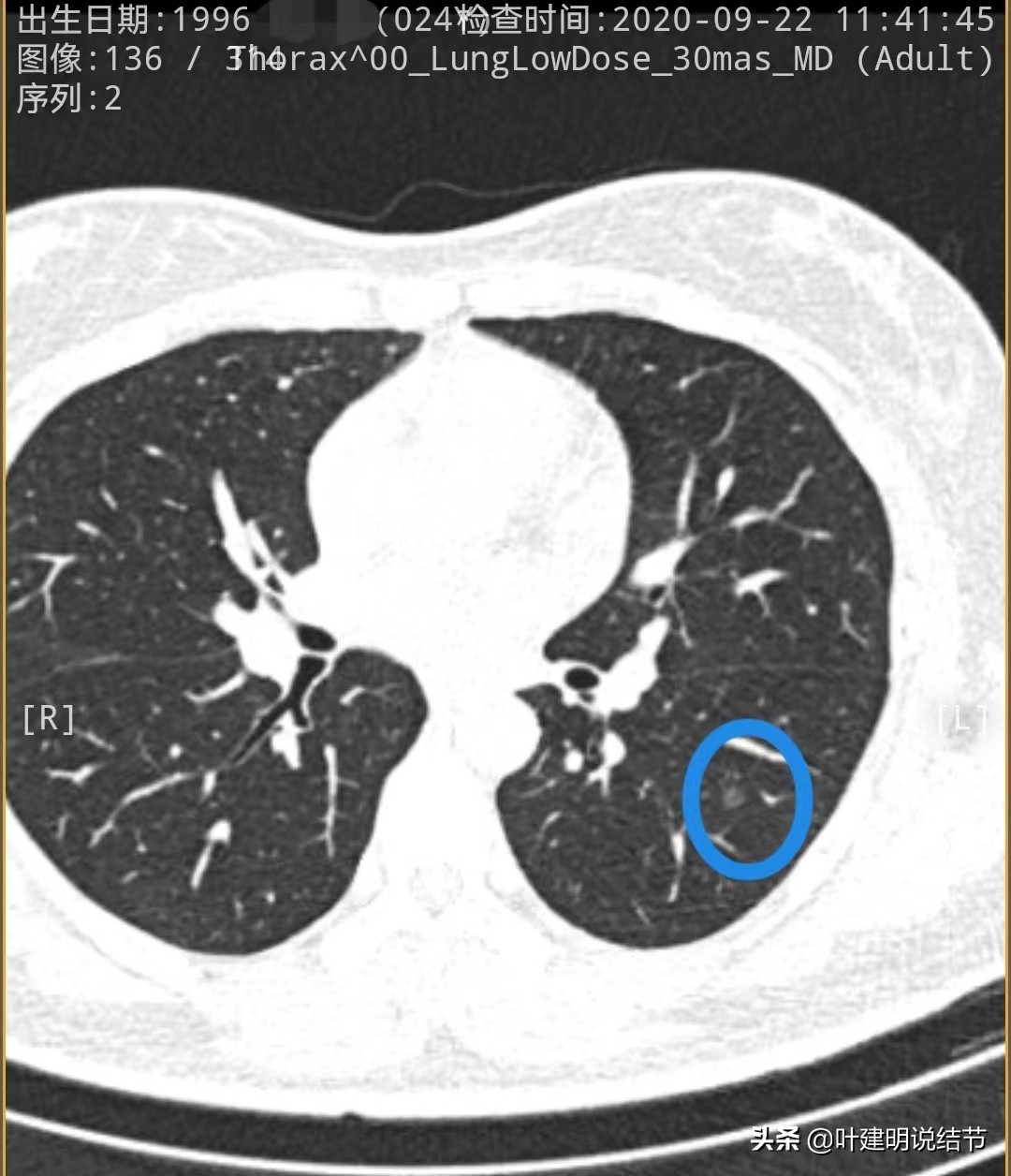 27岁女博士查出肺癌,年轻人多发肺结节怎么治愈