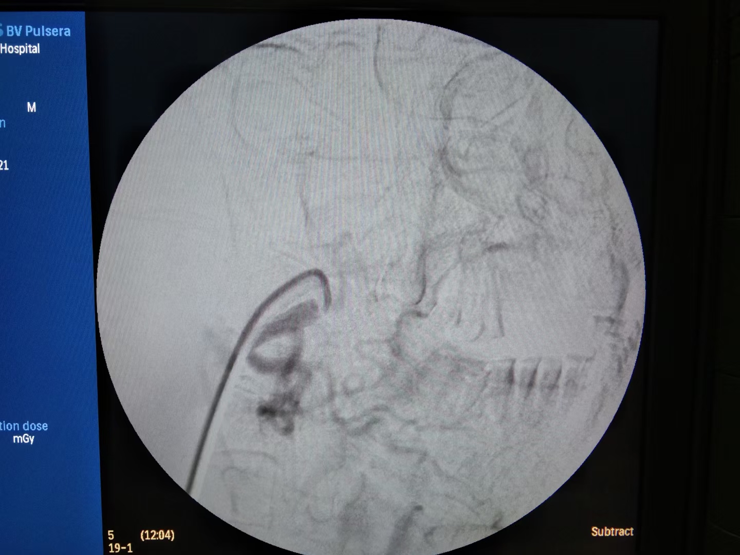 舌癌病例分享,舌癌吐血