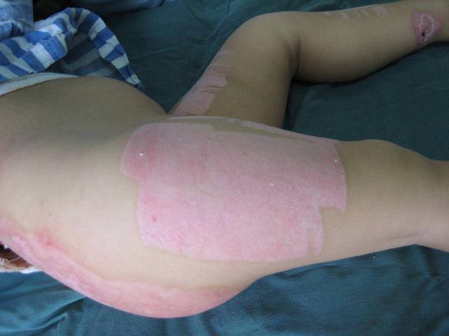 十大最痛苦的手术是什么,十种最痛的手术