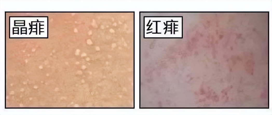 生活中最常见的4种皮肤病,皮肤科可以看多种皮肤病吗
