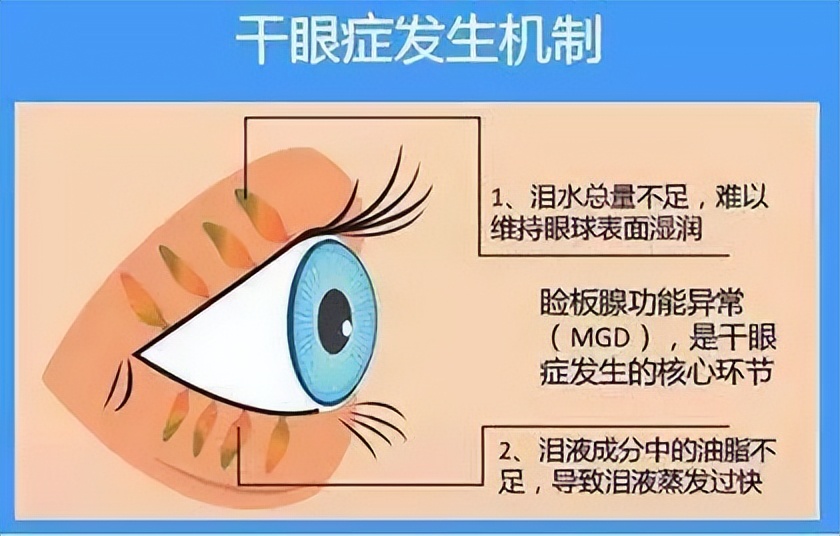 眼睛干痒模糊买什么眼药水好,网红眼药水小心眼睛越用越干
