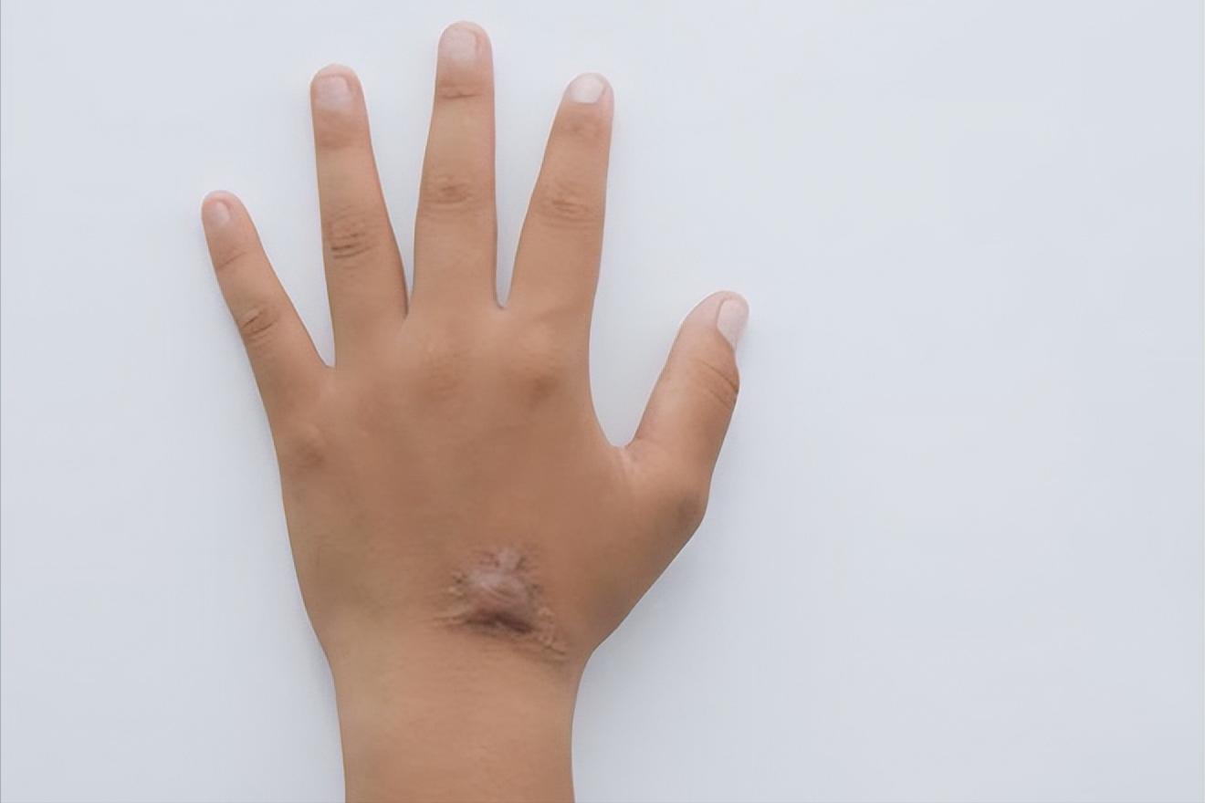 瘢痕疙瘩怎么治疗复发率小,瘢痕疙瘩持续增长怎么办