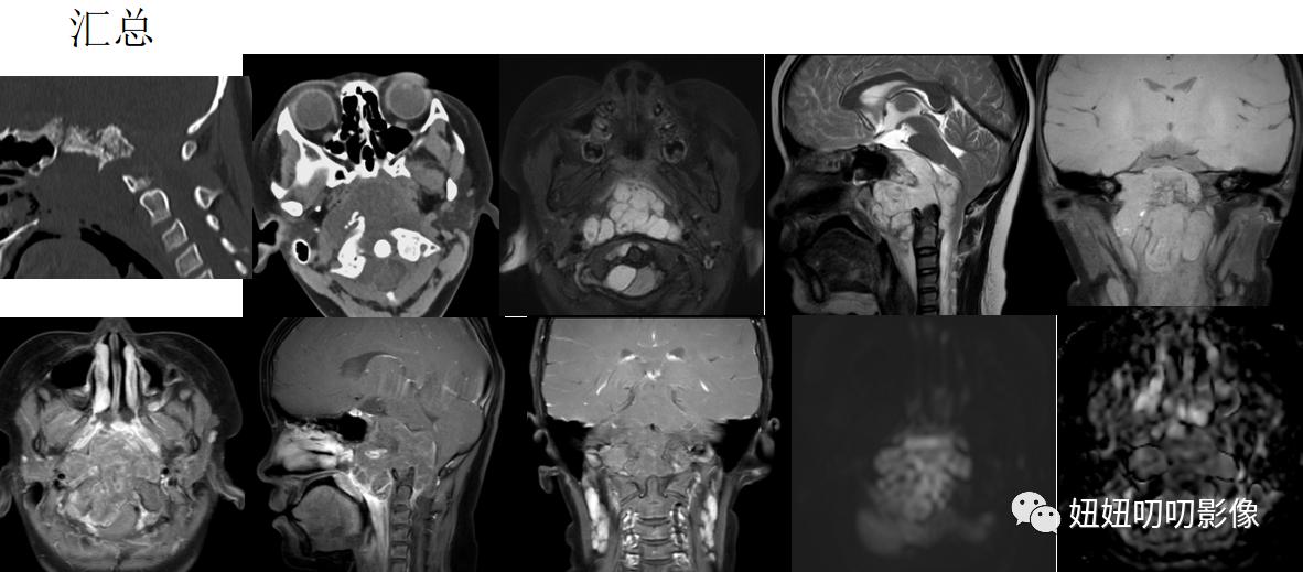 脊索瘤核磁表现,颅底ct头颅ct啥区别