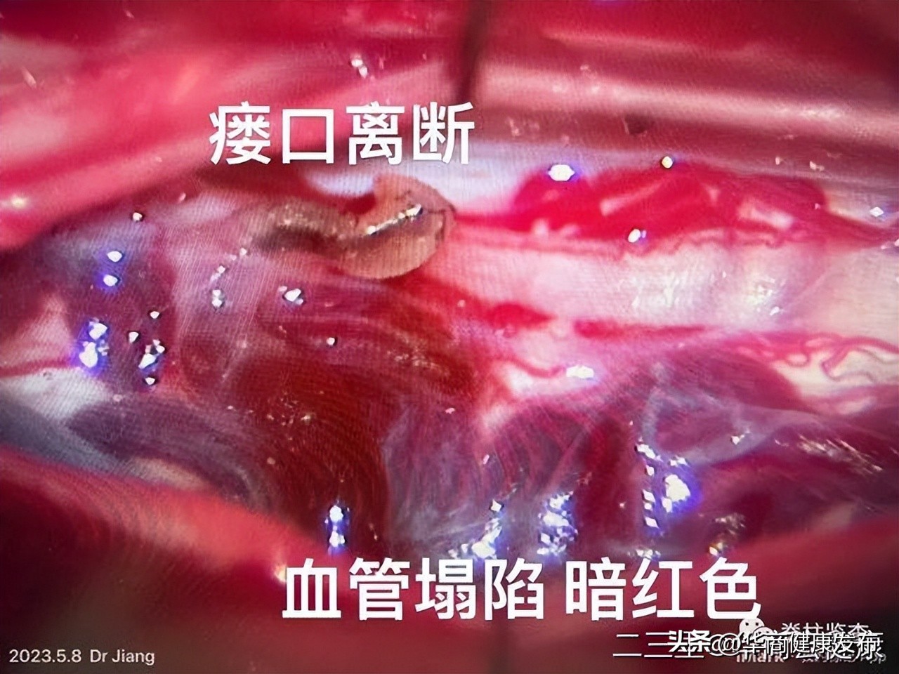 下肢无力一定是腰突引起的吗,腰椎硬脊膜瘘的症状和治疗