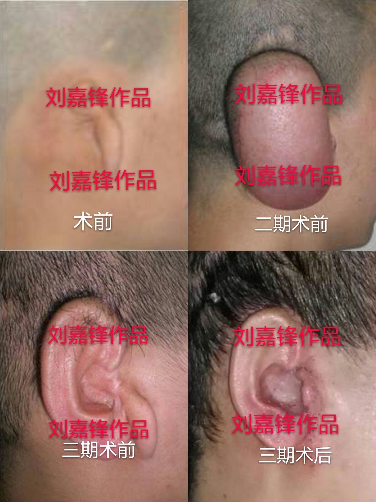 小耳畸形耳再造扩张法流程详解,小耳畸形再造二期手术