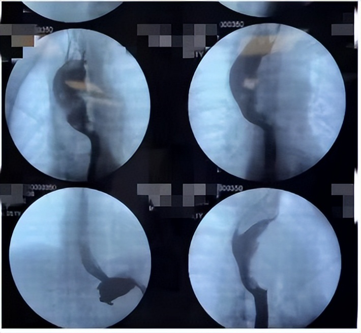 吴镜湘教授：胸科手术“下气道困难”的麻醉管理